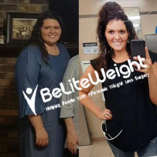 Weight Loss Surgery Gastric Sleeve before and after Katie - 2 Year Update*
